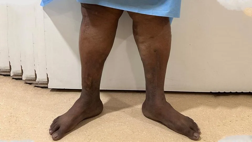 vascular pain in legs treatment | Vein and Foot Clinic